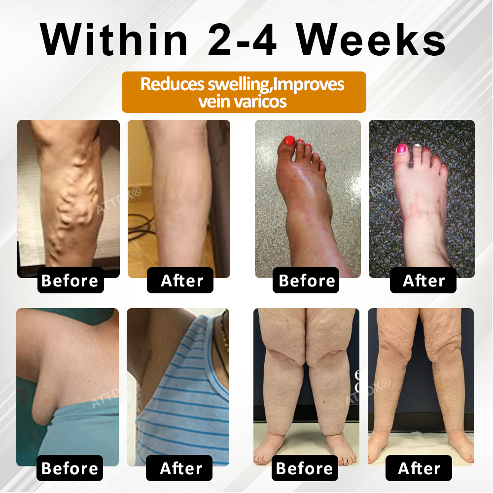 ATTDX® ApisChestnut Herbal Edema Relief Cream