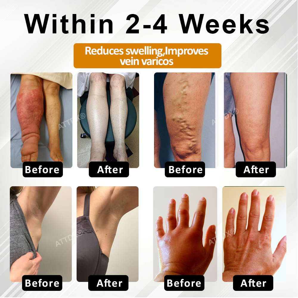 ATTDX® ApisChestnut Herbal Edema Relief Cream