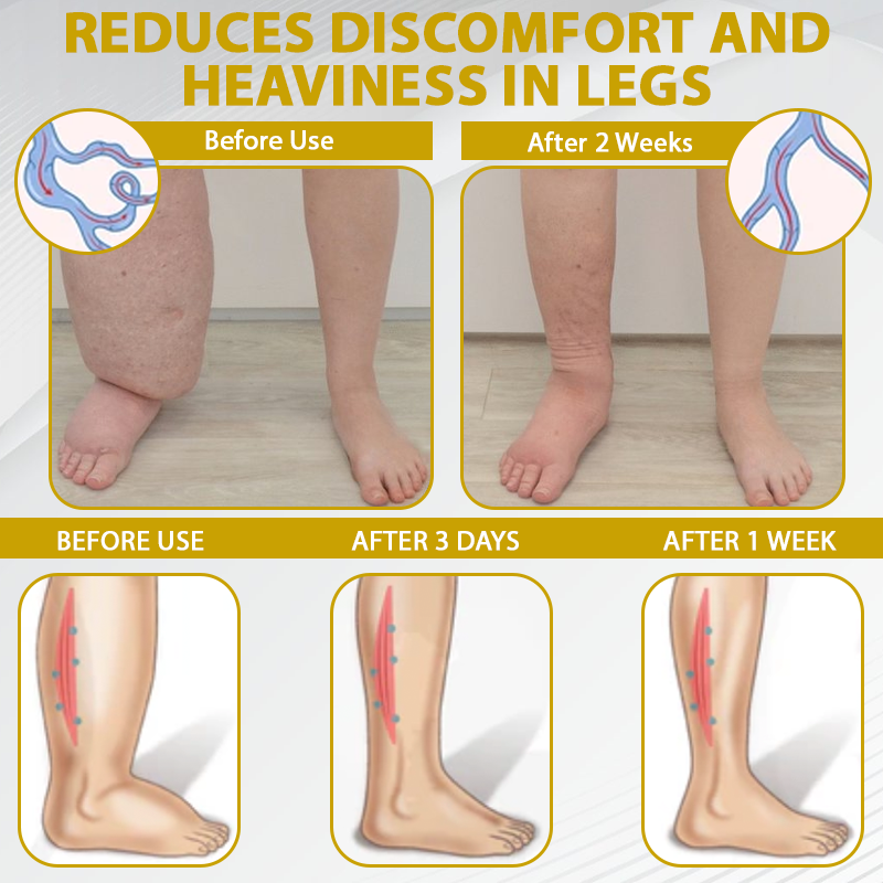 ATTDX® ApisChestnut Herbal Edema Relief Cream