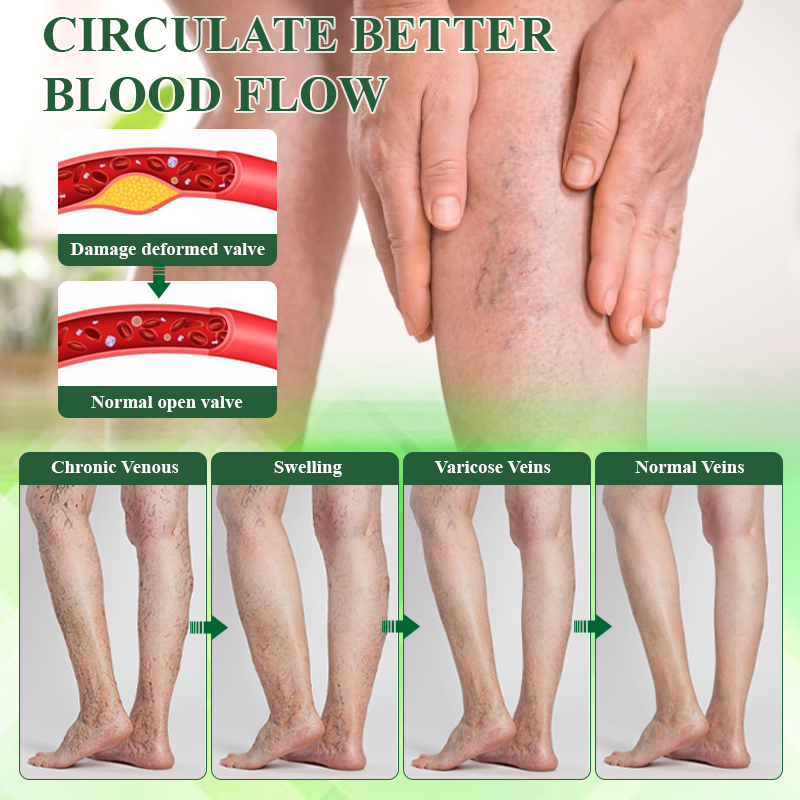 ATTDX® VeinoRoll Therapy Edema Comfort Cream