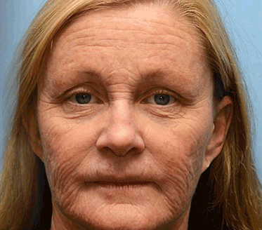 ApisDerm™ Botox BeeVenom WrinkleFirming Multi-Purpose Cream 2