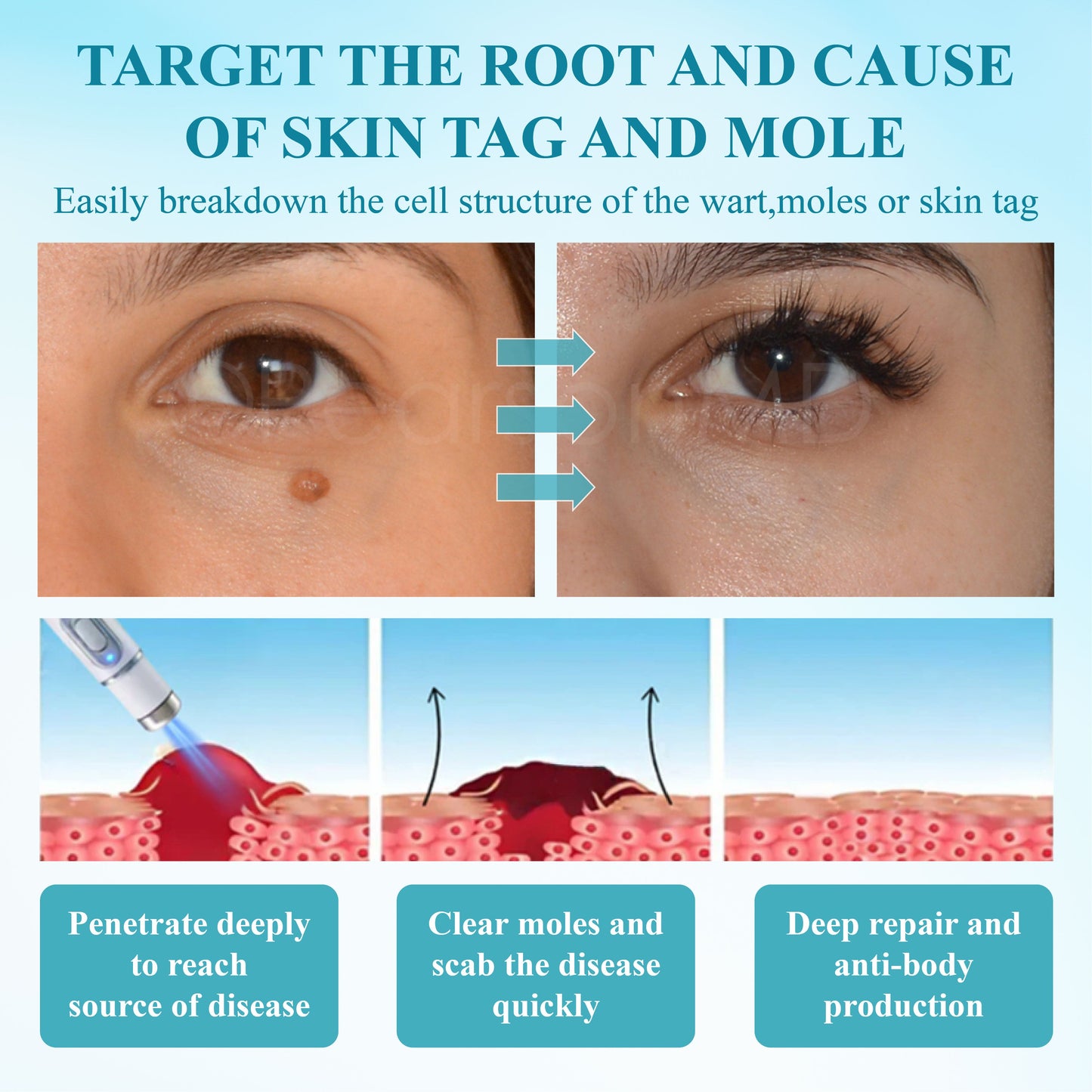 RICPIND® DermaLite Mole and Wart Removal Laser Pen